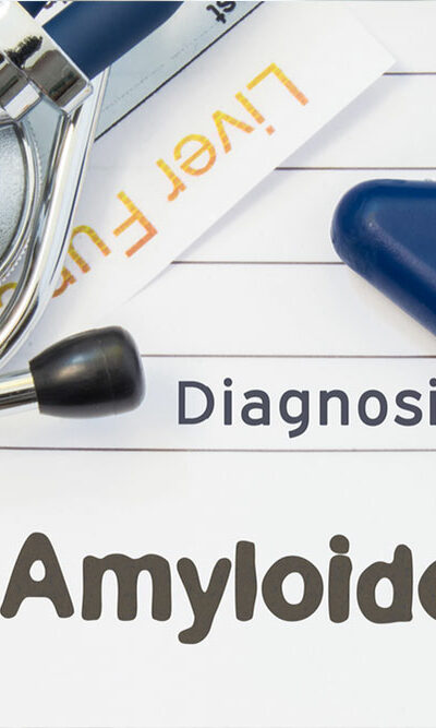 5 natural treatment options for amyloidosis