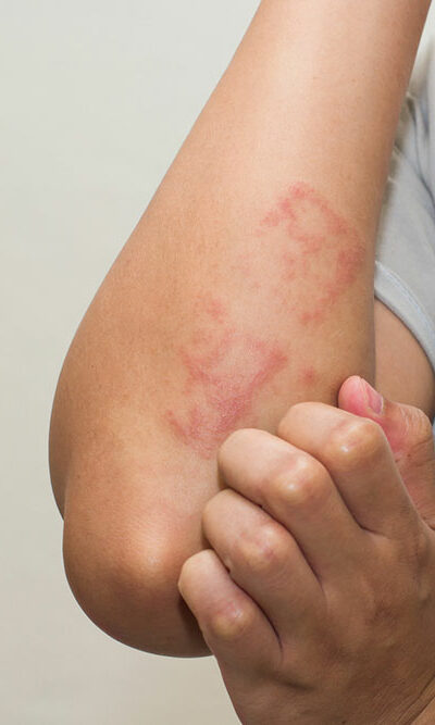 Common Types and Treatments of Eczematous Dermatitis