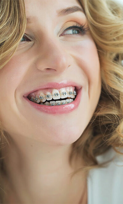 A guide to adult braces
