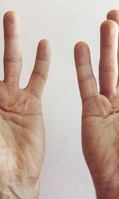 Dupuytren’s Contracture – Its Symptoms and Causes