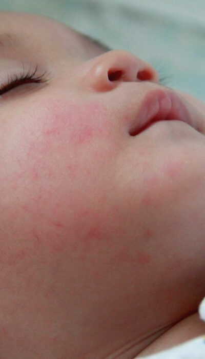 Eczema in Children – Overview, Tests, and Beneficial Foods