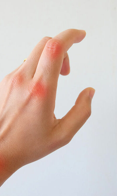 Key Symptoms and Treatments of Arthritis