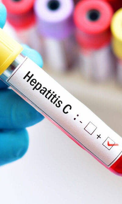 Hepatitis – types and contributing factors