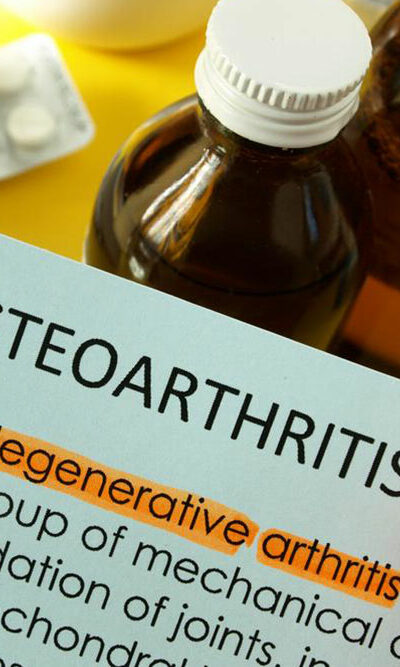 Osteoarthritis – How to Treat it