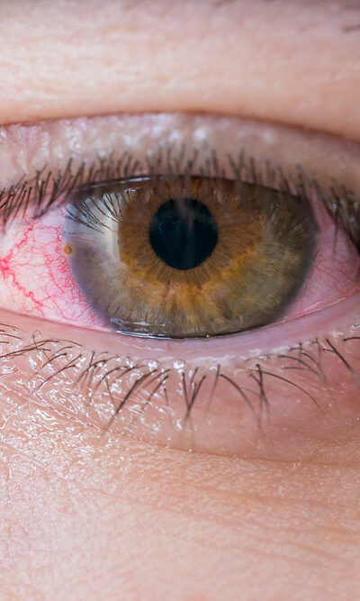 Red Eyes – Common Symptoms, Causes, and Treatment