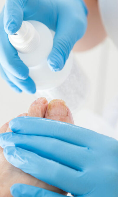 Toenail Fungus – Symptoms and Treatment Methods