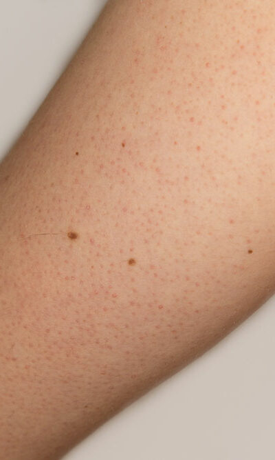 Top Treatment Options for Keratosis Pilaris