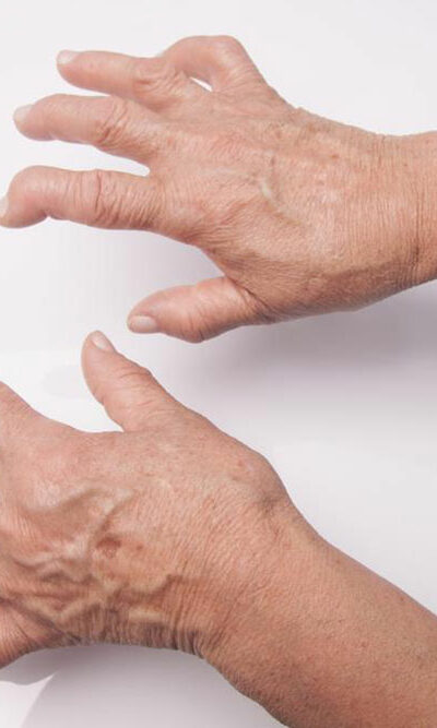 The Most Common Rheumatoid Arthritis Treatments