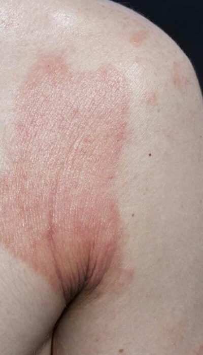 Contact Dermatitis – Symptoms, Causes, and Treatment Options
