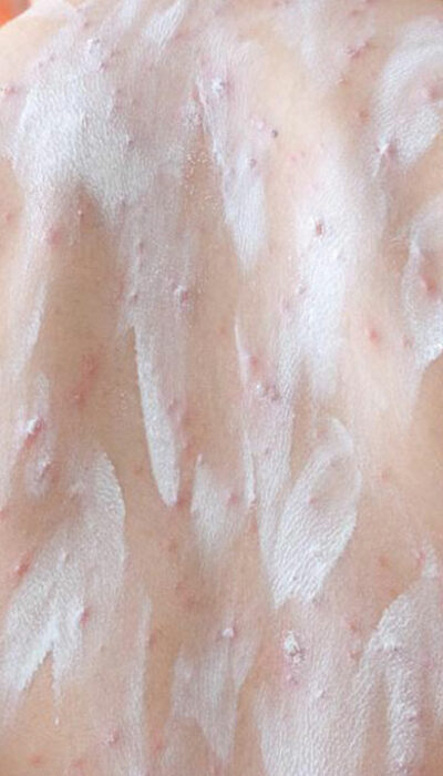Atopic Dermatitis – Treatment Options That Can Be Tried at Home