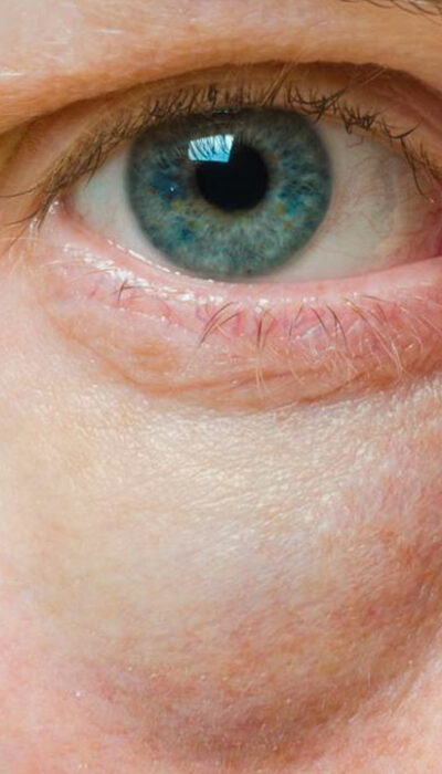 Bags Under the Eyes – Symptoms, Causes, and Treatment