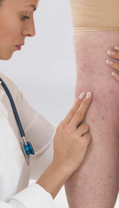 Effective Treatment for Varicose Veins