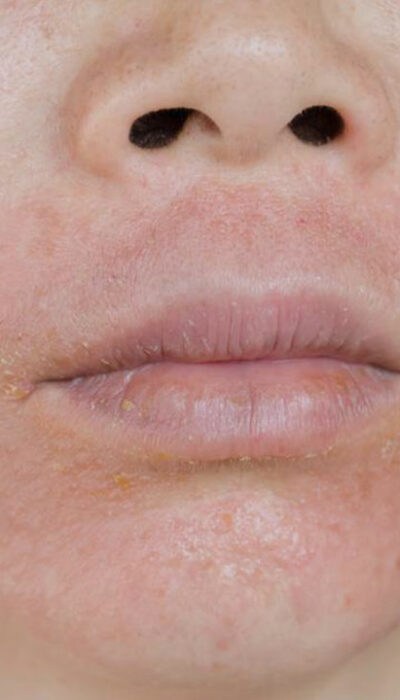 Effective Treatments for Eczema