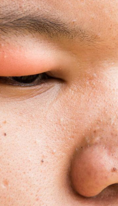 Here’s How to Get Rid of a Stye With These Simple Steps
