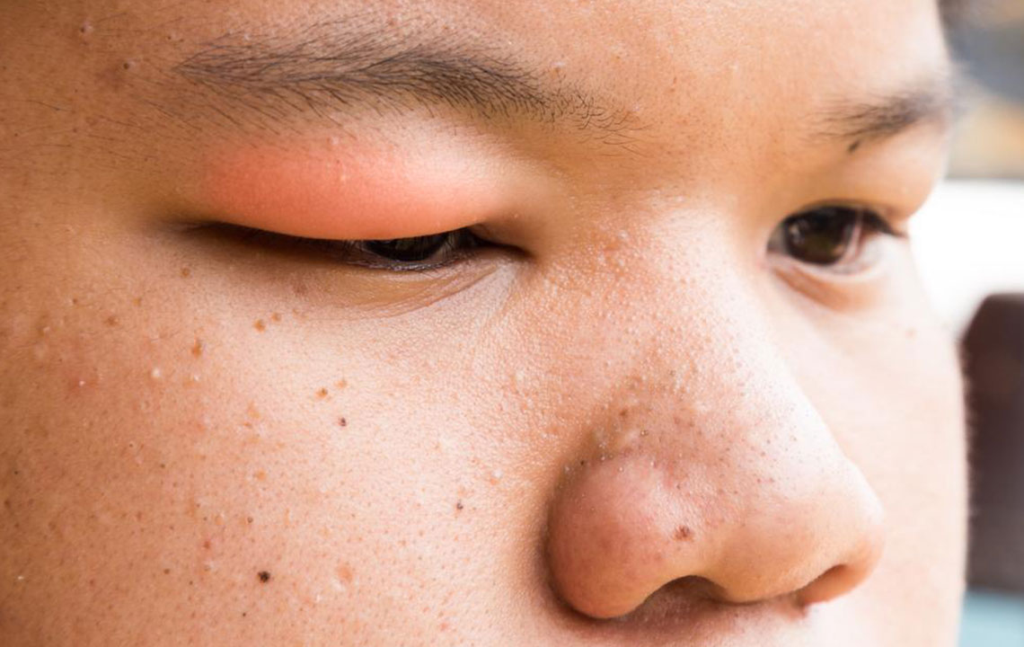 Here’s How to Get Rid of a Stye With These Simple Steps