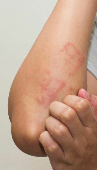 Lupus Skin Rash – Symptoms and Treatment