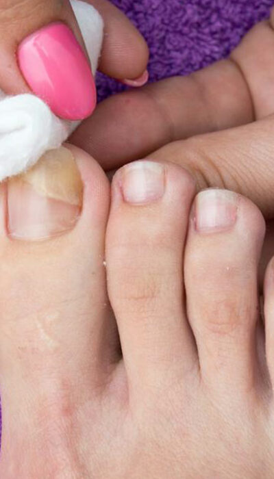 Nail Fungus – Causes, Symptoms, and Cure