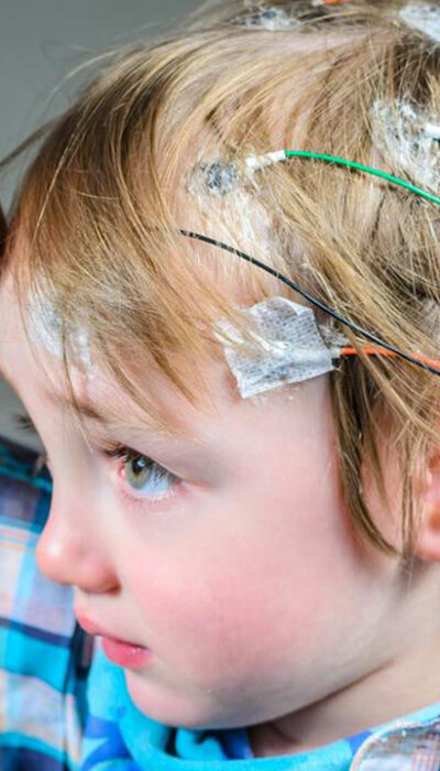 Seizures – Symptoms and Treatment