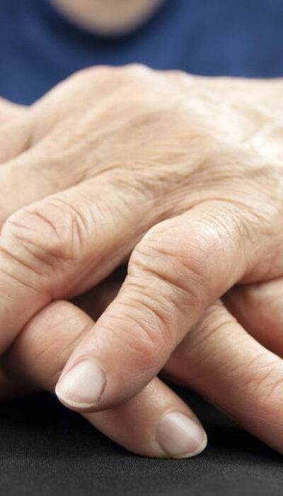 Rheumatoid Arthritis – Symptoms, Causes, and Remedies