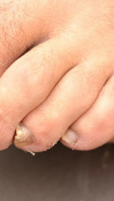 Toenail Fungus – Causes, Symptoms and Treatment
