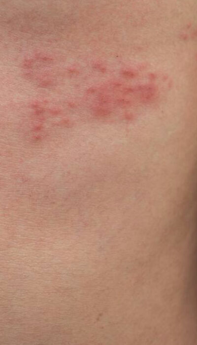 Top 3 Simple Treatments for Shingles You Need to Know