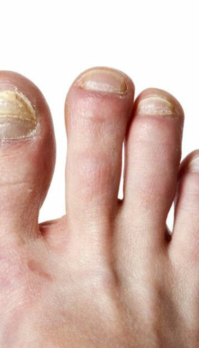 Tried and Tested Natural Cure for Toenail Fungus