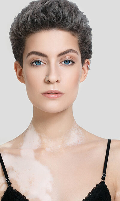 4 ways to prevent the progression of vitiligo