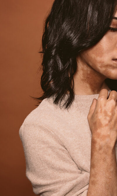 Repigmentation – Its role in managing vitiligo